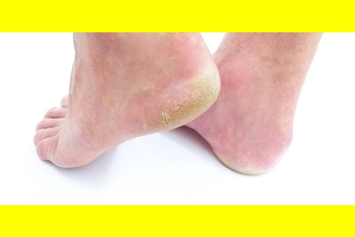 Cracked Heels