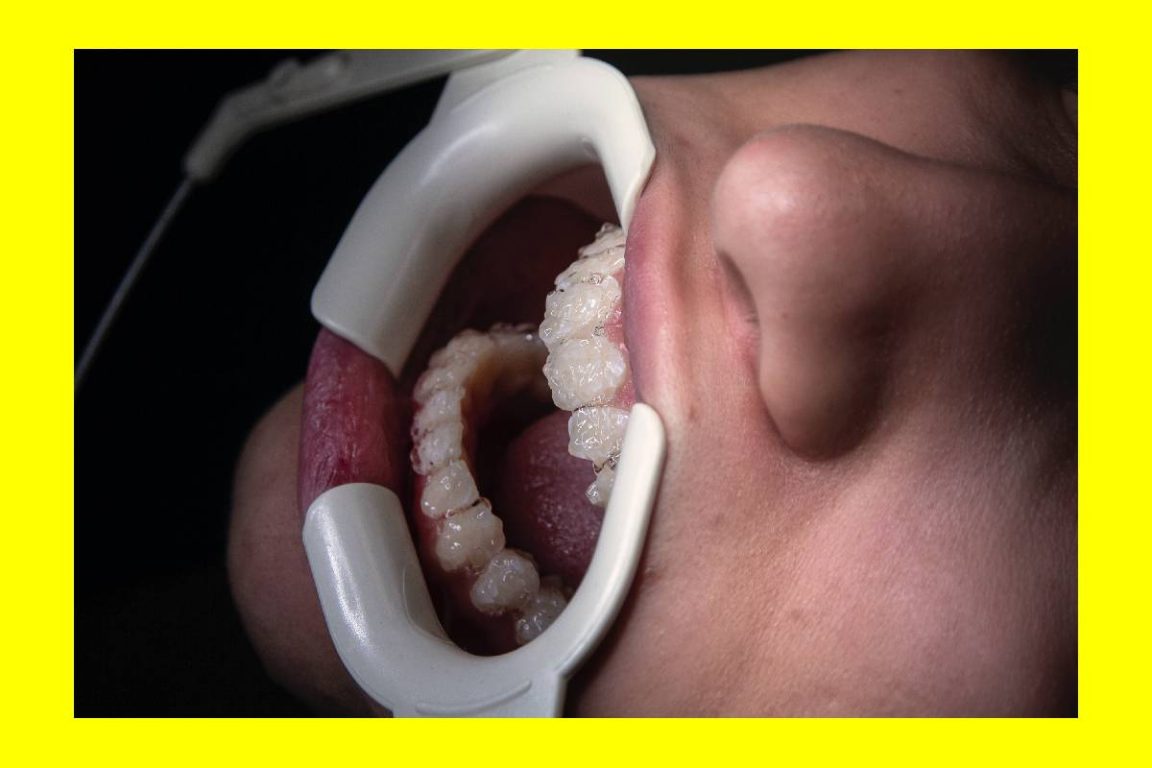 Essential Root Canal