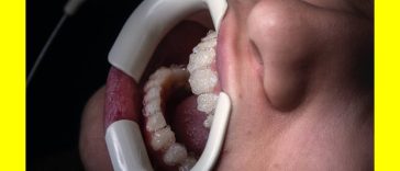 Essential Root Canal