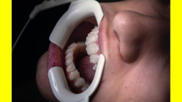 Essential Root Canal