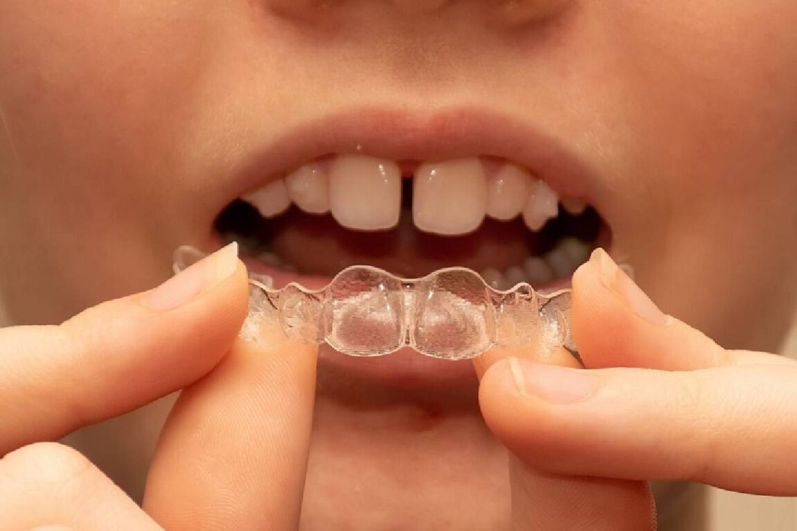 Bridging the Gap_ Exploring Teeth Gap Filling Options