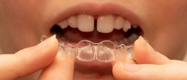 Bridging the Gap_ Exploring Teeth Gap Filling Options