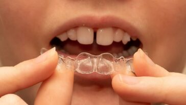 Bridging the Gap_ Exploring Teeth Gap Filling Options