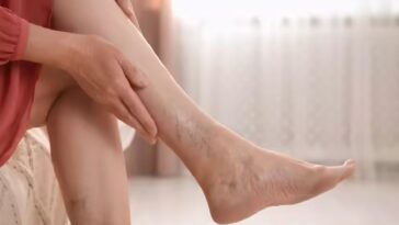 Healthy Circulation, Healthy Life_ Everyday Habits to Prevent Varicose Veins