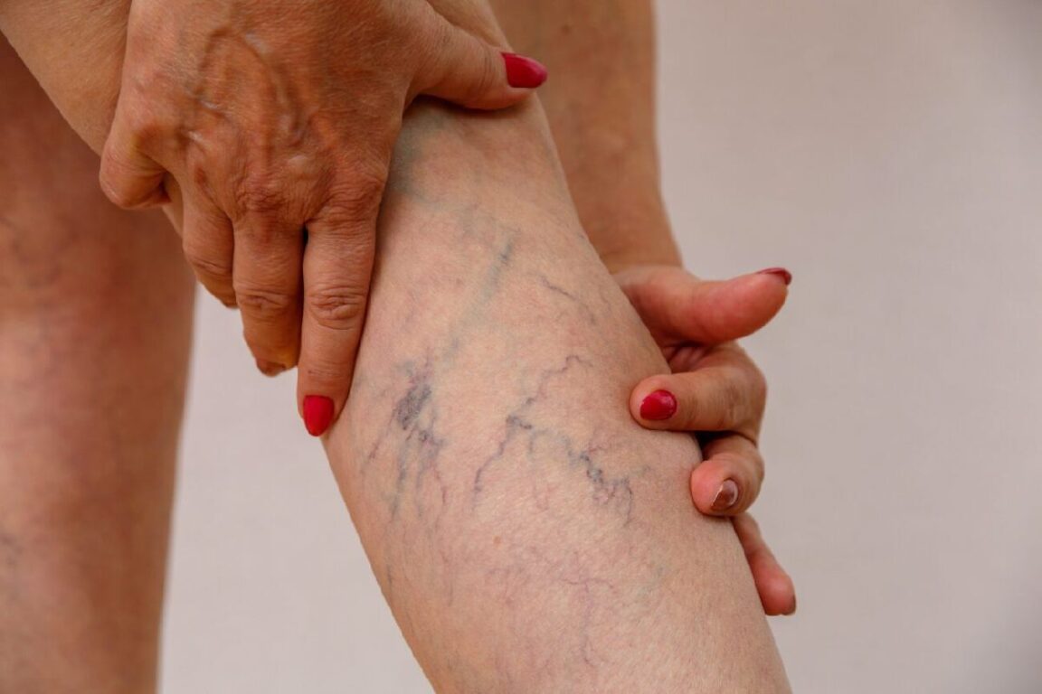 Why Varicose Veins Are More Than a Cosmetic Issue: A Complete Guide to Risks, Diagnosis, and Modern Treatment Options