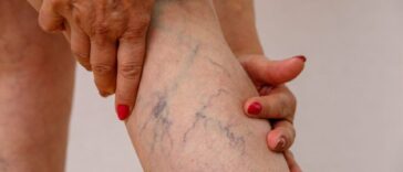 Why Varicose Veins Are More Than a Cosmetic Issue: A Complete Guide to Risks, Diagnosis, and Modern Treatment Options