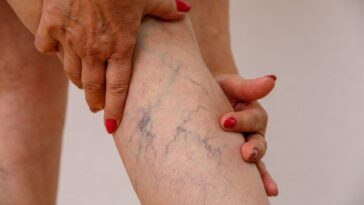 Why Varicose Veins Are More Than a Cosmetic Issue: A Complete Guide to Risks, Diagnosis, and Modern Treatment Options