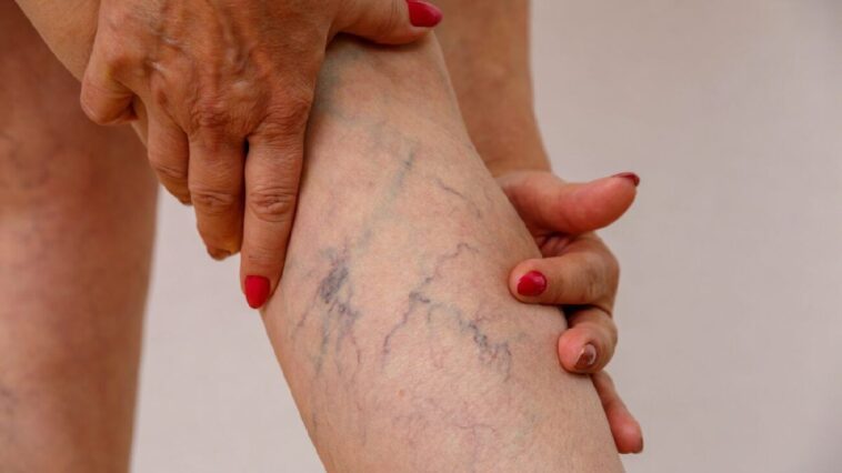 Why Varicose Veins Are More Than a Cosmetic Issue: A Complete Guide to Risks, Diagnosis, and Modern Treatment Options