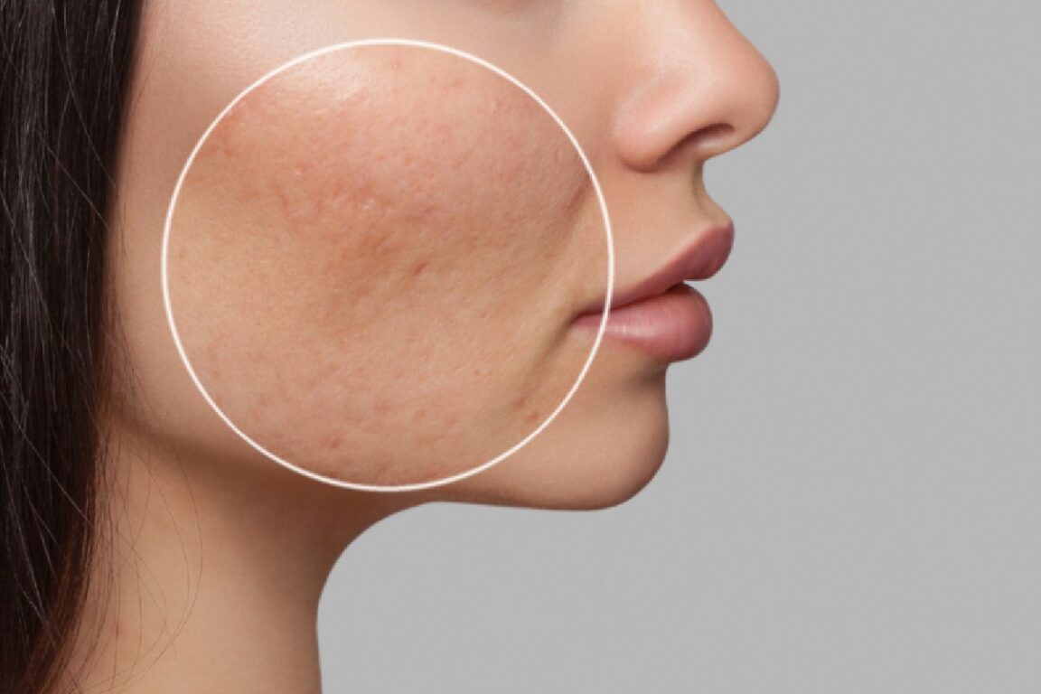 Clinical Approaches to Treating Acne Scars Safely and Effectively