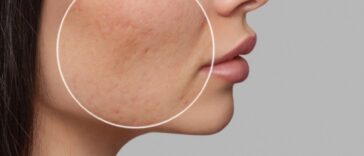 Clinical Approaches to Treating Acne Scars Safely and Effectively