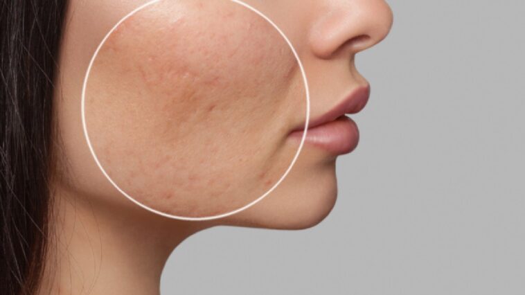 Clinical Approaches to Treating Acne Scars Safely and Effectively