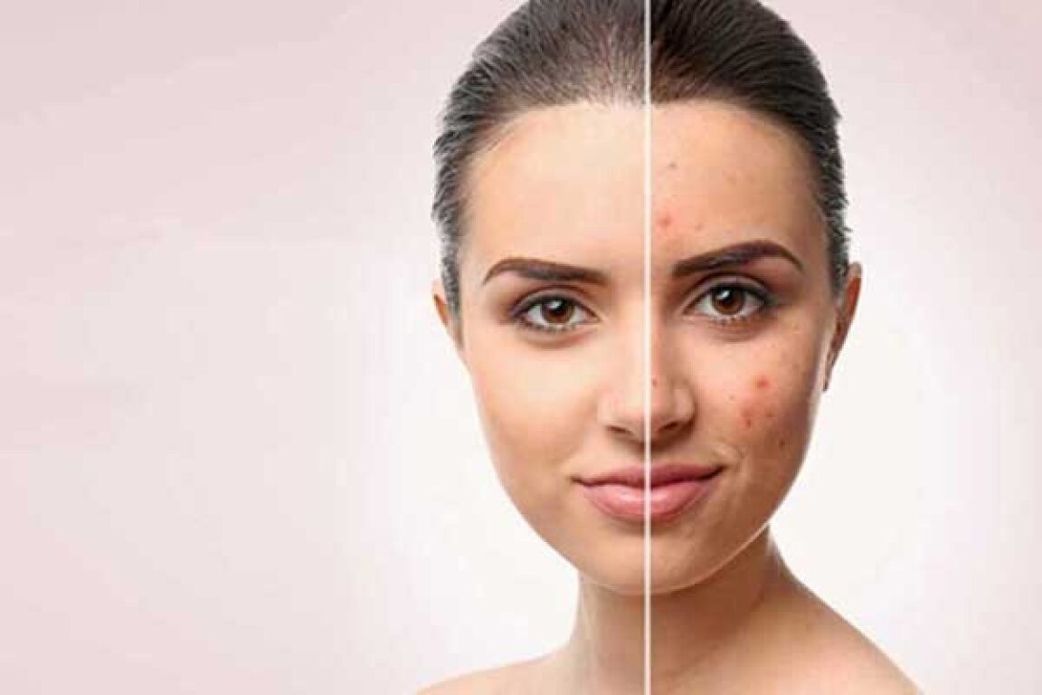 How Does Acne Scar Removal Differ from General Scar Treatment?