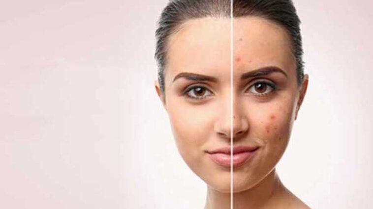 How Does Acne Scar Removal Differ from General Scar Treatment?