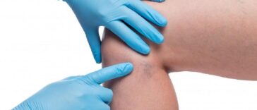 How to Choose a Vein Specialist in a Major City: What Patients Should Look For