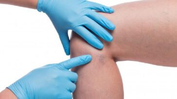 How to Choose a Vein Specialist in a Major City: What Patients Should Look For