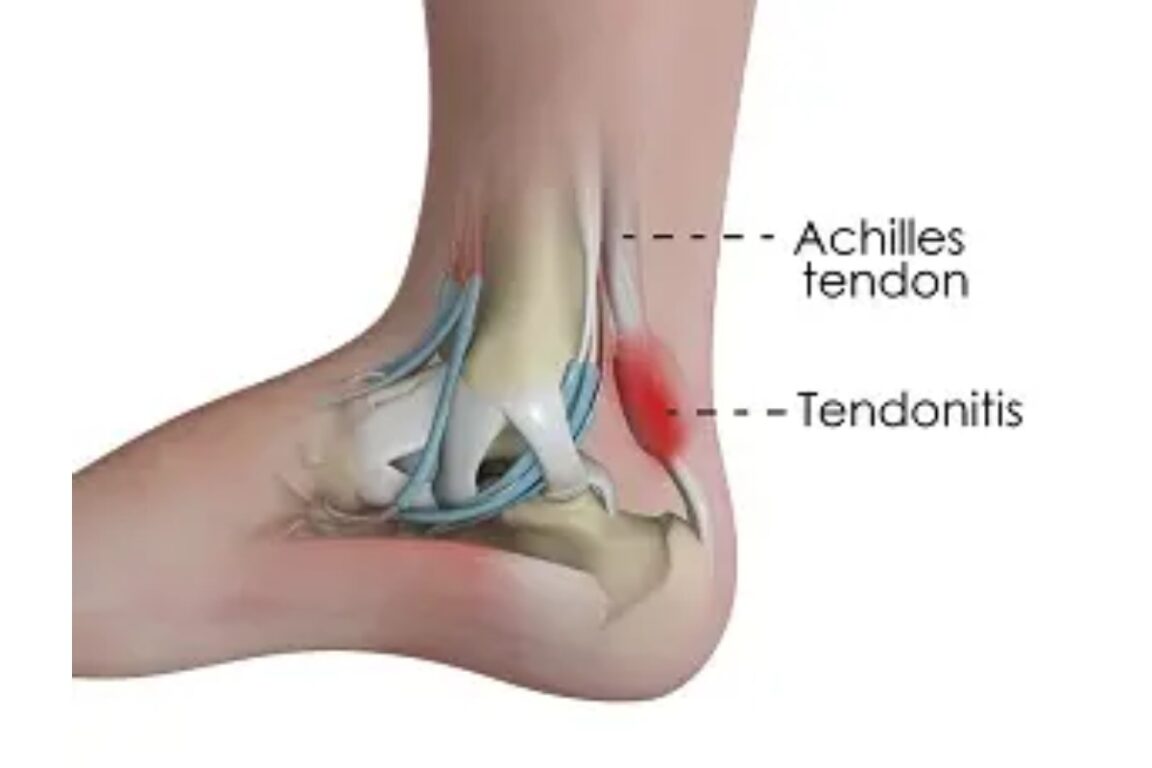 Understanding Achilles Tendinitis