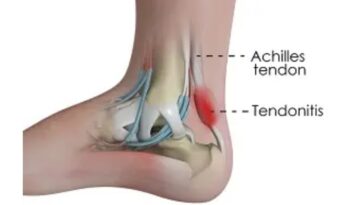 Understanding Achilles Tendinitis