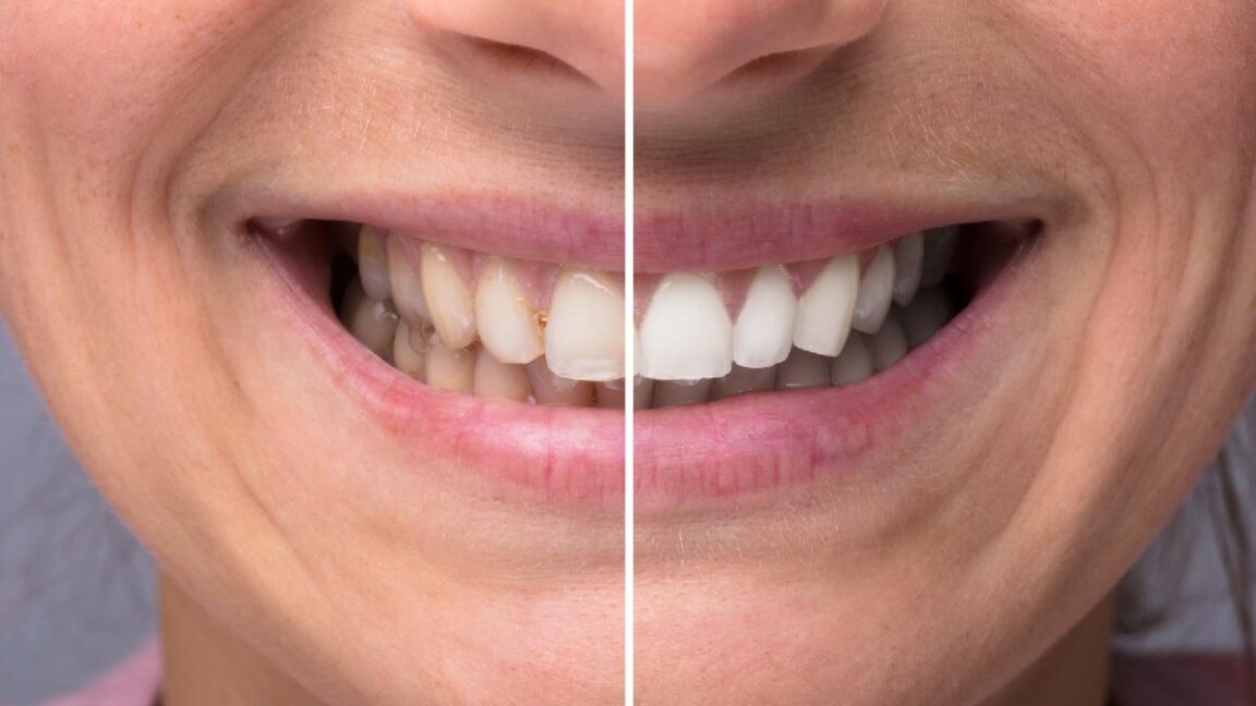 How Long Do Teeth Whitening Results Last in Manhattan Beach?