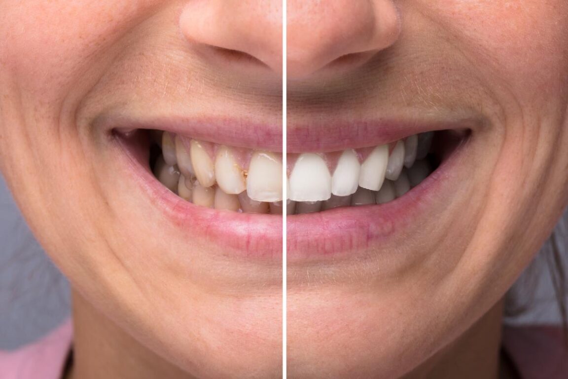 How Long Do Teeth Whitening Results Last in Manhattan Beach?