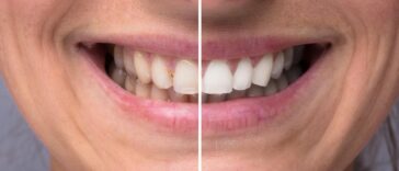 How Long Do Teeth Whitening Results Last in Manhattan Beach?