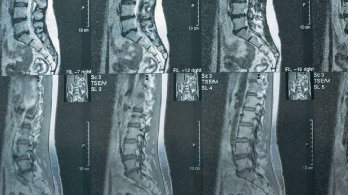Dr. Salvatore Palumbo Illustrates How Integrated Pain Management and Neurosurgery Work Together to Treat Complex Spine Disorders 