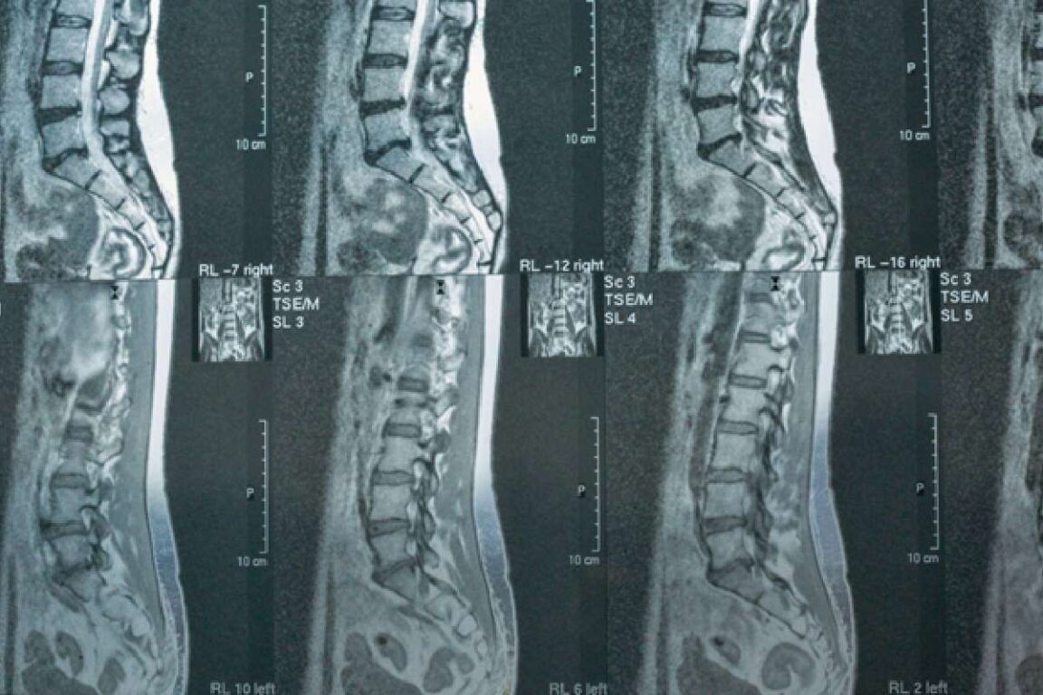 Dr. Salvatore Palumbo Illustrates How Integrated Pain Management and Neurosurgery Work Together to Treat Complex Spine Disorders