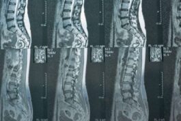 Dr. Salvatore Palumbo Illustrates How Integrated Pain Management and Neurosurgery Work Together to Treat Complex Spine Disorders 