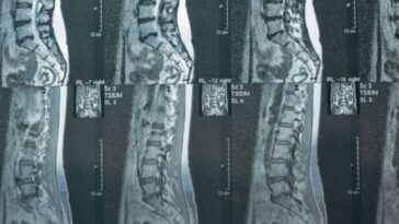 Dr. Salvatore Palumbo Illustrates How Integrated Pain Management and Neurosurgery Work Together to Treat Complex Spine Disorders 